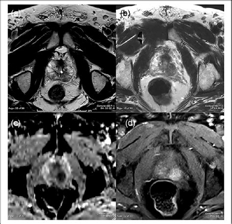 Figure 1 From Bacillus Calmette Guérin Therapy Induced Granulomatous