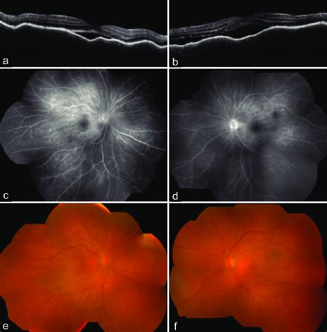 Patient 12 Was A Case Of So That Occurred After Smooth Cataract