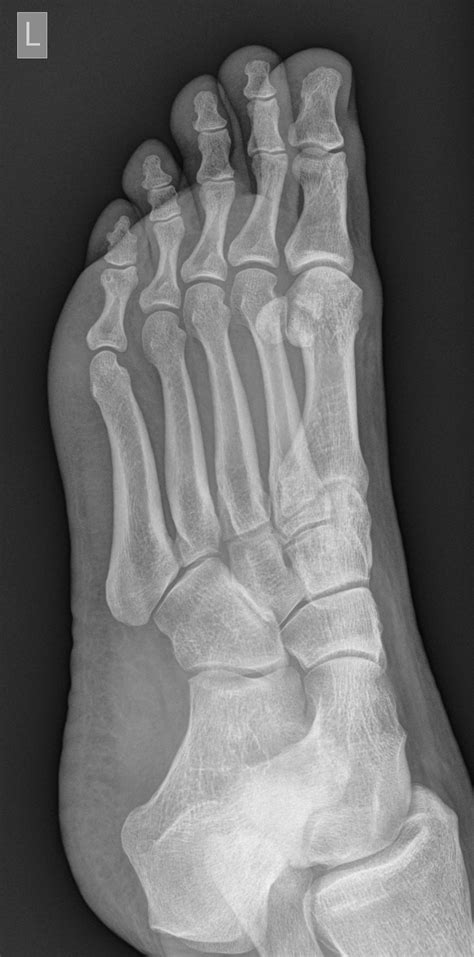 Bipartite Hallux Sesamoid Diastasis Image Radiopaedia Org