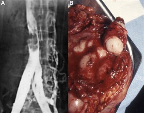 Techniques For Inferior Vena Cava Resection And Reconstruction For