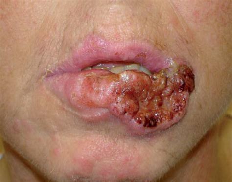 Mouth Cancer Early Stages