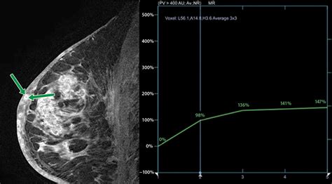 Inflammatory Breast Cancer Mammogram