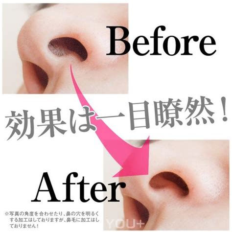 ノーズワックス 5回分 脱毛 鼻毛 ブラジリアンワックスメール便送料無料 Ycm Nose Wax 5packユープラス 通販