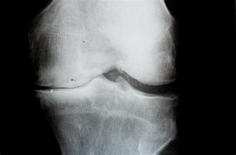 Image De Rayon X D articulation Du Genou Avec L arthrose Avancée