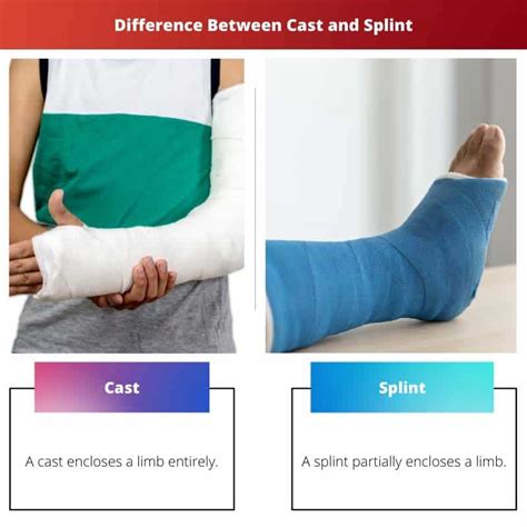 Cast Vs Splint Ero Ja Vertailu