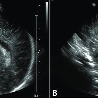 Coronal View Of Head Ultrasonography Shows 1 2 Cm Sized Lt