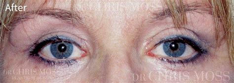 Eyelid Surgery Blepharoplasty Dr Chris Moss Melbourne