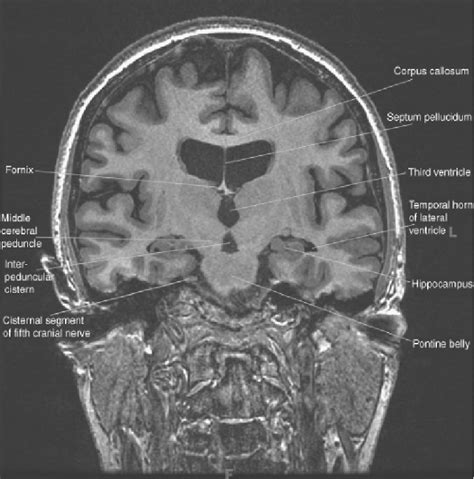 Brain MRI. Coronal plane T1-weighted image showing the third ventricles ...