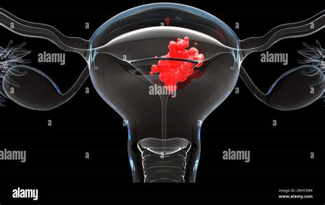 uterus malignant tumor, Female uterus anatomy, Reproductive system ...