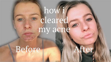 Acne Skin Care Routine How I Cleared My Cystic Acne Youtube