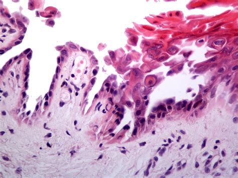 Darier Disease Histology