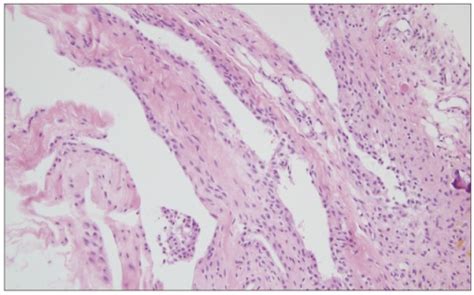 Synovial Cyst Histology