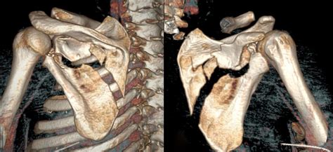 Fractura de escápula Traumacor