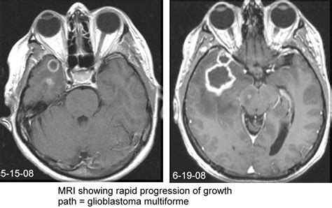 Mri Picture Of A Glioblastoma