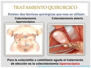 Colecistitis Aguda Y Colelitiasis Ppt