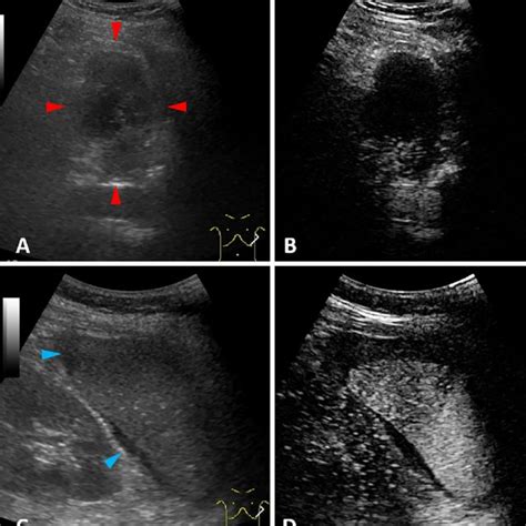 Figure2 A Ultrasonography Us Findings Showing A Hypoechoic Download Scientific Diagram