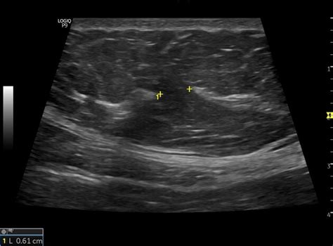 Transversalis Fascia Defects