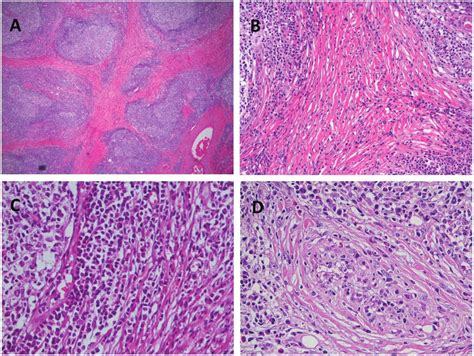 Typical Histopathology Of Immunoglobulin G4 Related Chronic Sclerosing