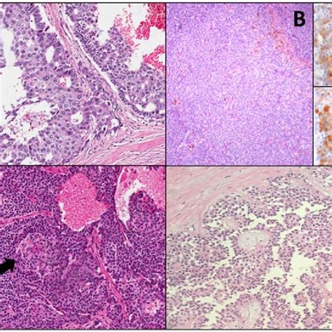 A Representative Microscopic Image Of An Acinar Cell Carcinoma With