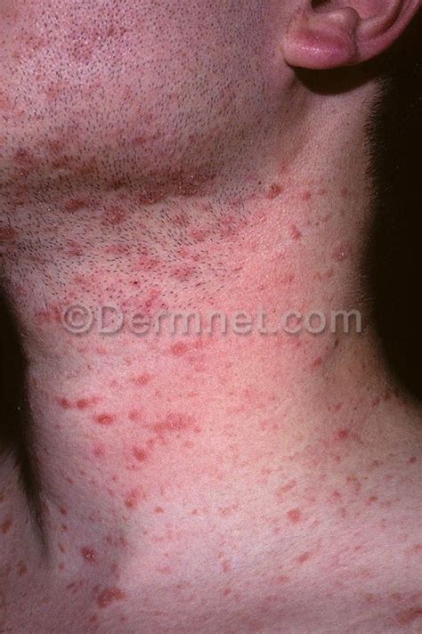 what causes ringworm in human - pictures, photos