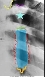 Bony Thorax Flashcards Quizlet