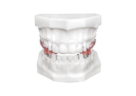 Orthodontic Appliances Universal Orthodontic Lab