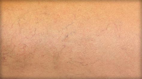 Varicose Veins Spider Or Reticular Veins Peripheral Vascular Disease