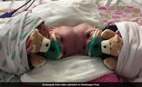 Doctors Just Separated Twin Girls Joined At The Head In One Of The Worlds Rarest Surgeries