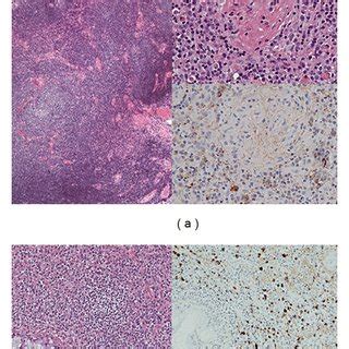 Histological findings in a typical case of orbital IgG4-related ...