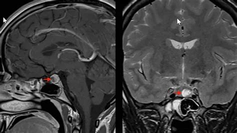 PITUITARY MRI – Alex Scan