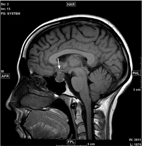 Rare Presentation Of Ewing Sarcoma Metastasis To The Sella And