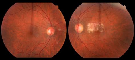 Acute Retinal Necrosis Arn Retina Associates