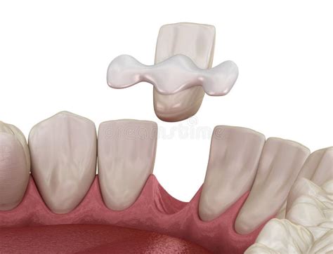 Maryland Bridge Made From Ceramic Front Tooth Recovery Medically