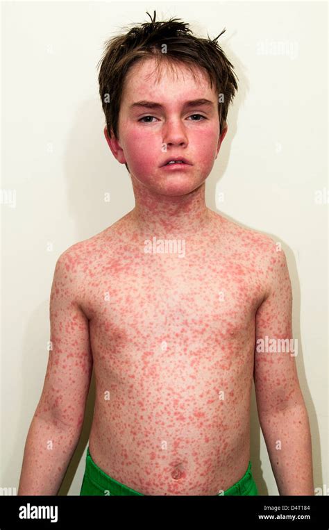 Young Boy With A Rash Caused By An Allergic Reaction Stock Photo Alamy