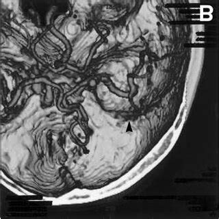 Preoperative Three Dimensional Computed Tomography Angiography D Cta