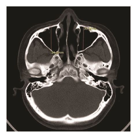 Linear Measurements Of Anteroposterior Dimensions Of Maxillary Sinus