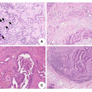 Histopathological Features Associated With Lymph Node Metastasis In