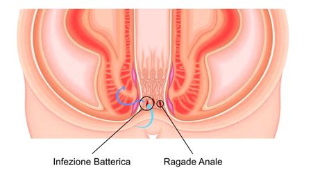 Le ragadi anali Cause sintomi e rimedi efficaci Dr Niccolò Ghezzi