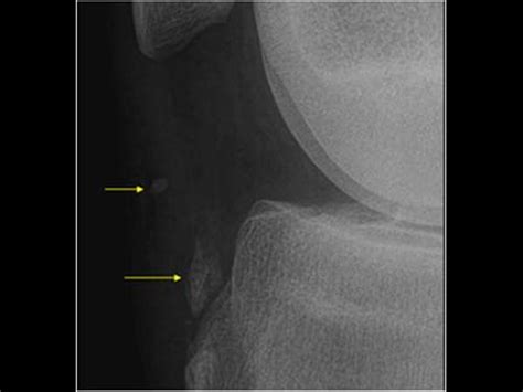 Icd 10 Code For G T Bursitis