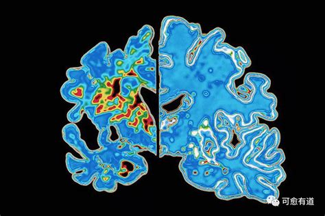 阿尔茨海默病新药leqembi获fda完全批准可愈有道