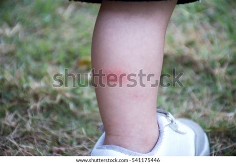 Rashes On Legs Children Stock Photo 541175446 | Shutterstock