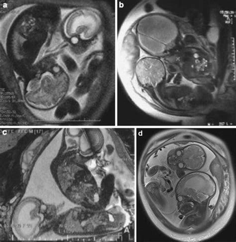 Fetal Hydrocephalus And Its Treatment In Utero Springerlink