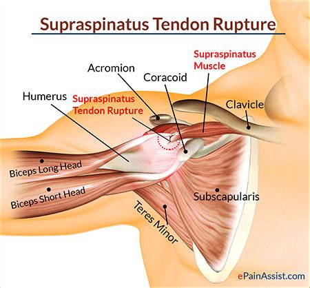 Shoulder Tendonitis Treatment NYC | Shoulder Tendonitis Specialist