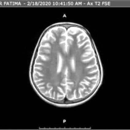 Axial MRI images at the level of third ventricle showing no abnormality ...