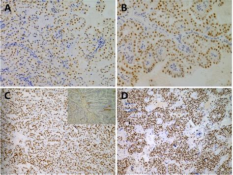 Exploration Of Clinicopathological Features Of Rearranged Renal Cell