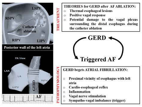 Life Free Full Text Gastro Esophageal Reflux Disease And Paroxysmal Atrial Fibrillation Ablation