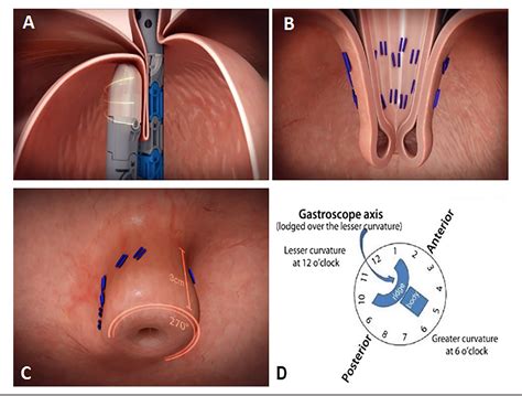 Figure 1 From Response Of Laryngopharyngeal Symptoms To Transoral