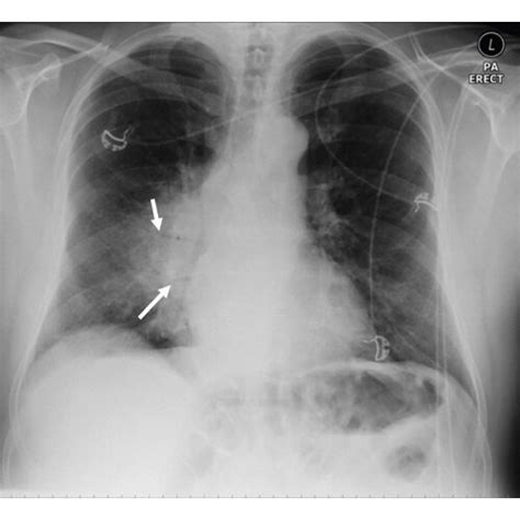 CXR On Admission Demonstrating Dense Right Perihilar Consolidation With