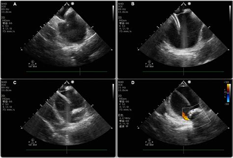 Frontiers Intracardiac Echocardiography Chinese Expert Consensus