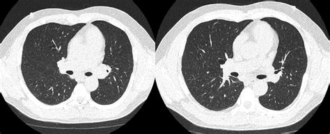 Ct Chest Without Contrast Axial Images Demonstrate Multiple